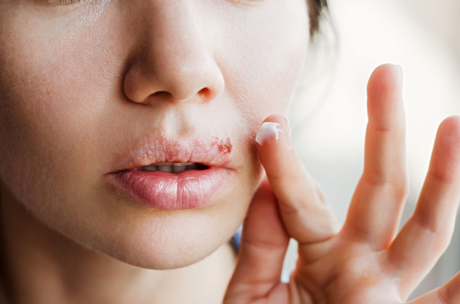 Herpes labiale: che cos'è e quando preoccuparsi