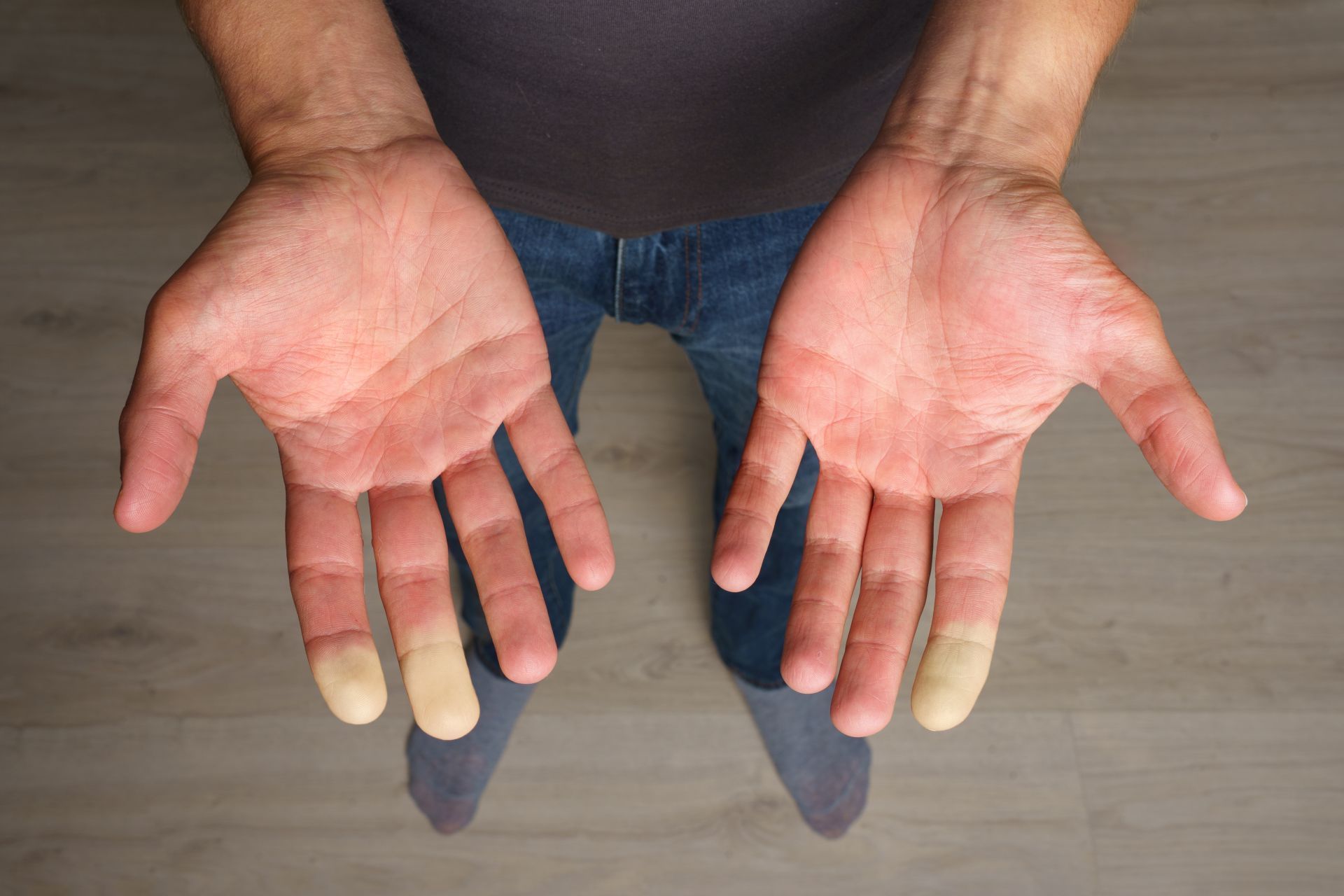 Fenomeno di Raynaud: cos'è e quali accertamenti eseguire
