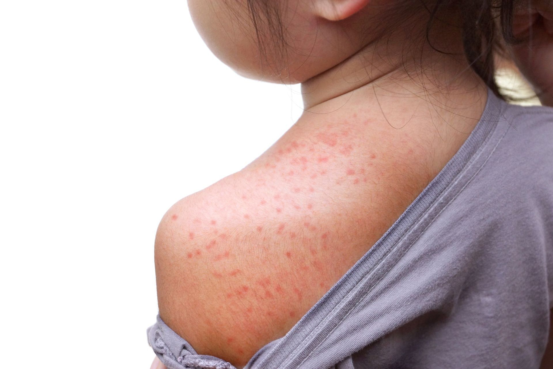 Sesta malattia: sintomi, trattamento e prevenzione