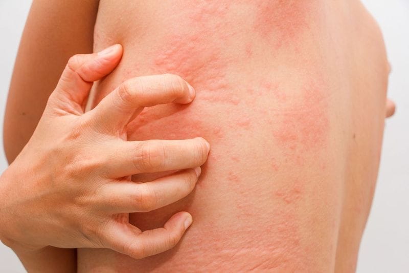 Orticaria: guida completa per gestirla efficaciemente