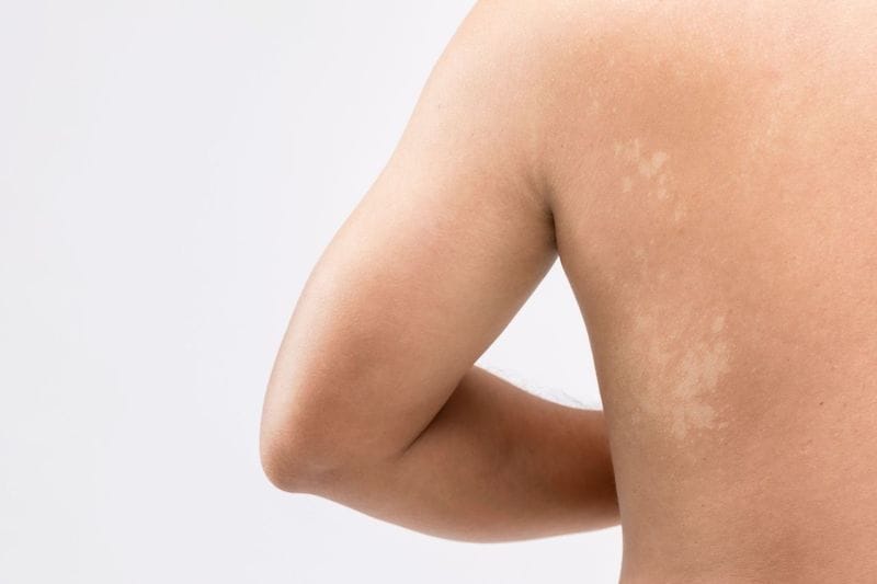 La pitiriasi versicolor: cos'è e come si può trattare