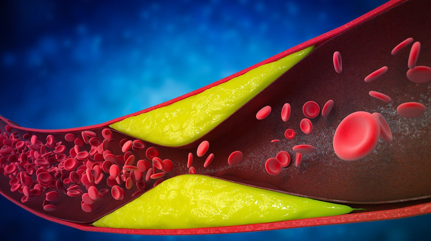 Rimedi naturali ed efficaci per l'ipercolesterolemia: guida completa